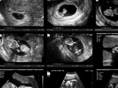 女性子宫肌瘤在常州市妇幼保健院做三代试管预算八万块够不够？